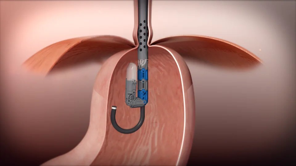 TIF Procedure
