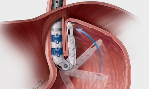 Transoral Incisionless Fundoplication (TIF) Procedure