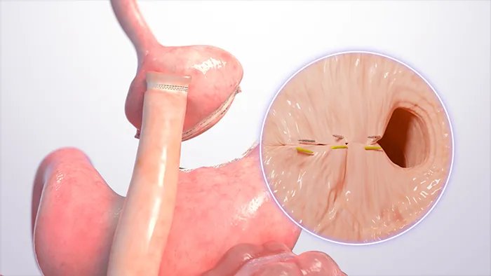 TORe Procedure