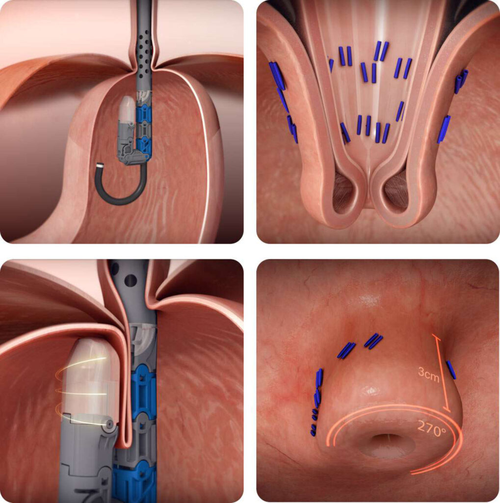 TIF procedure illustration